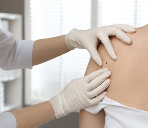 Dermatologist examining patient's birthmark in clinic, closeup view