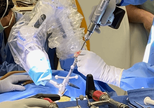 Physician performs Brainlab Cirq procedure