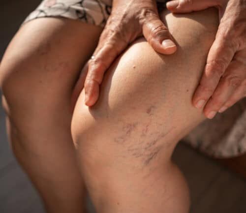 Treating broken capillaries