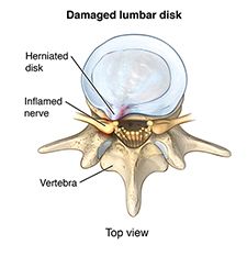 Damaged lumbar disk
