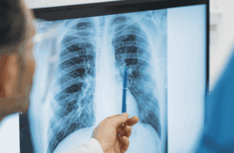 X-ray showing lungs