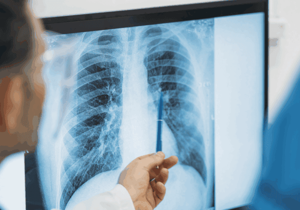 X-ray showing lungs