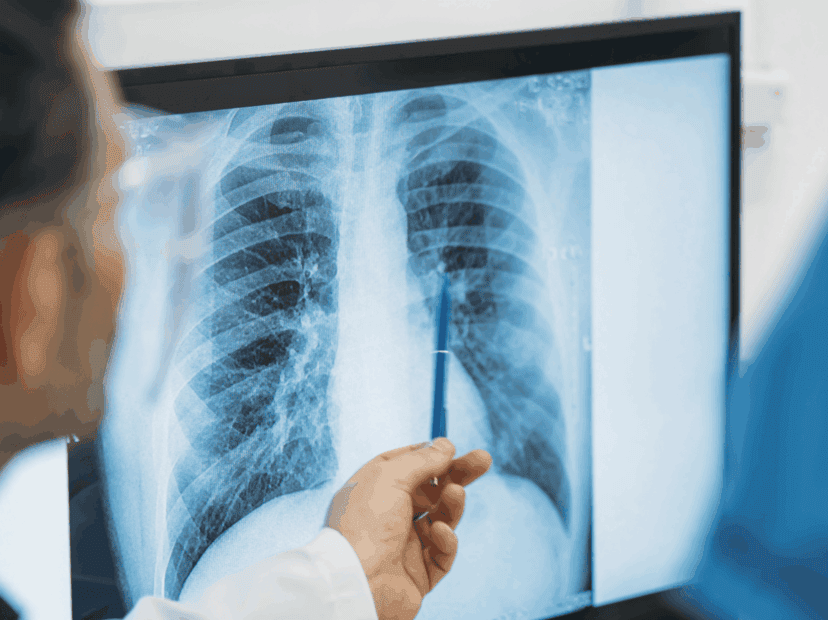 X-ray showing lungs