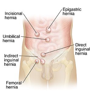 What is the Difference Between Inguinal Hernia and Femoral Hernia