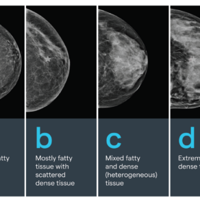 Measuring breast density