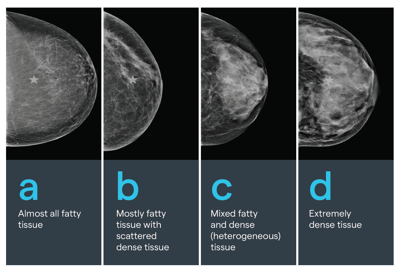 What Having Dense Breasts Means For Your Health