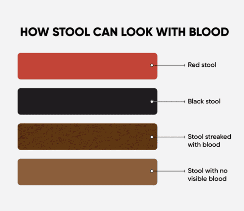 Four different colors of blood in stool