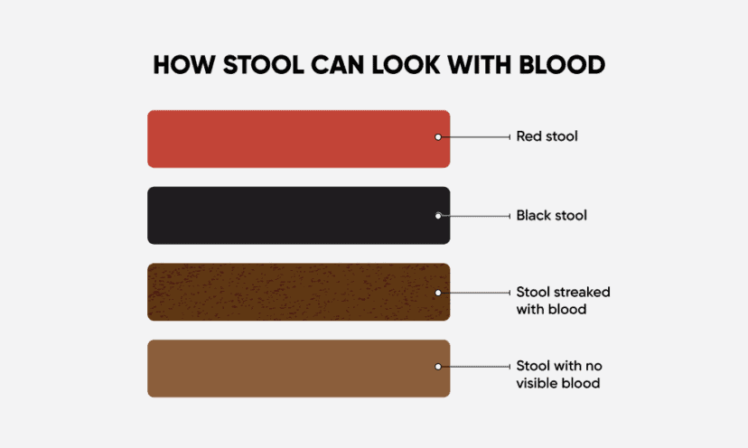 Four different colors of blood in stool